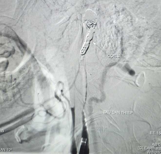 Chảy máu ồ ạt từ mũi và miệng, biến chứng nguy hiểm của ung thư vòm hầu- Ảnh 2.