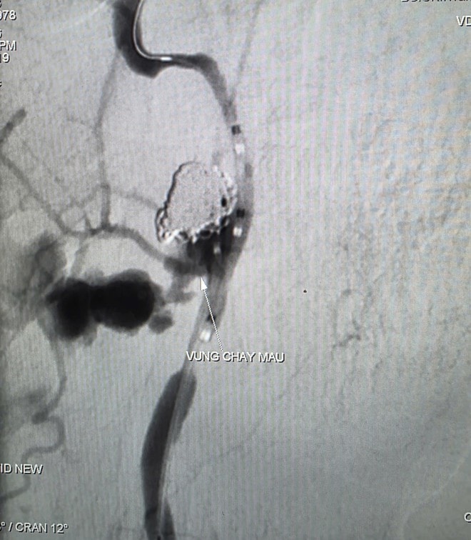 Chảy máu ồ ạt từ mũi và miệng, biến chứng nguy hiểm của ung thư vòm hầu- Ảnh 1.