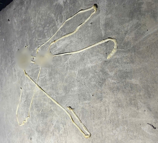 Phát hiện nhiều trường hợp nhiễm đa ký sinh trùng hiếm gặp ở Hải Phòng- Ảnh 1. Phát hiện nhiều trường hợp nhiễm đa ký sinh trùng hiếm gặp ở Hải Phòng- Ảnh 1.