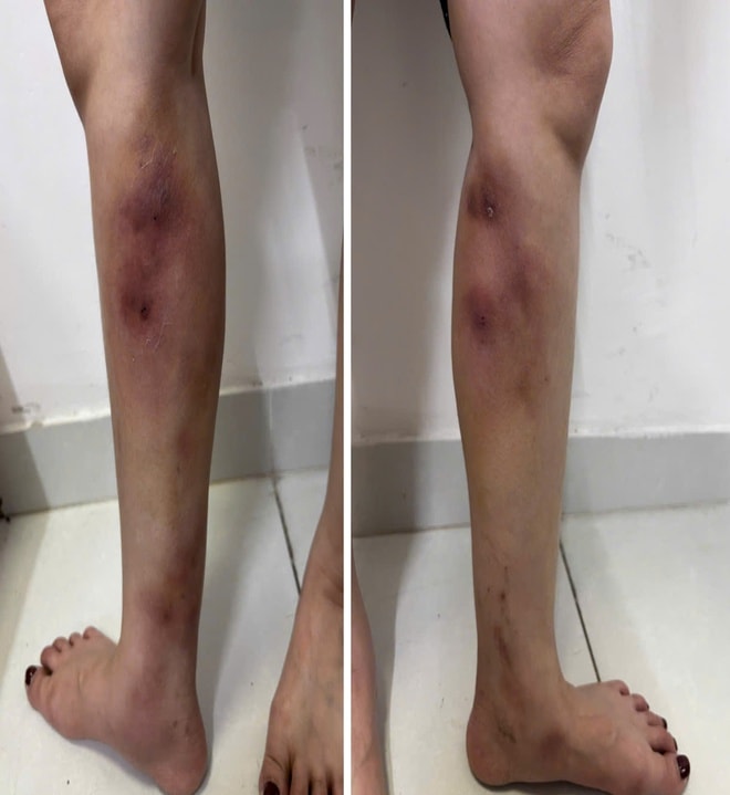 Cẳng chân người phụ nữ 29 tuổi biến dạng vì tiêm filler để làm... thẳng chân tại nhà- Ảnh 1. Cẳng chân người phụ nữ 29 tuổi biến dạng vì tiêm filler để làm... thẳng chân tại nhà- Ảnh 1.