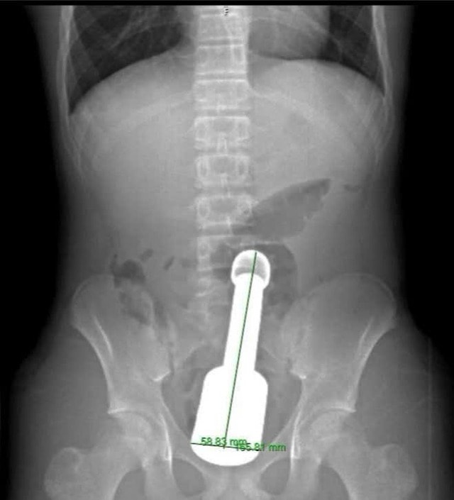 Thiếu niên 15 tuổi cấp cứu vì chiếc chày 18cm mắc kẹt hậu môn- Ảnh 2. Thiếu niên 15 tuổi cấp cứu vì chiếc chày 18cm mắc kẹt hậu môn- Ảnh 2.