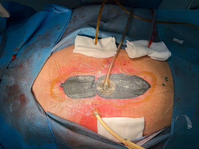 Đau bụng nhiều ngày, tự uống thuốc giảm đau, người đàn ông thủng dạ dày nguy kịch- Ảnh 2. Đau bụng nhiều ngày, tự uống thuốc giảm đau, người đàn ông thủng dạ dày nguy kịch- Ảnh 2.