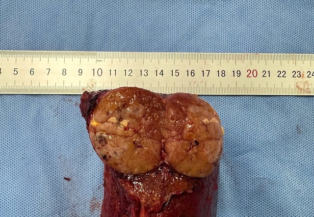 Phẫu thuật thành công ca u gan hiểm hóc từng bị từ chối điều trị- Ảnh 2.