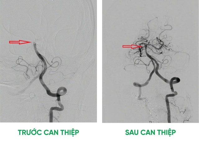 Can thiệp kịp thời, cứu sống bệnh nhân tắc động mạch thân nền nguy kịch- Ảnh 2.