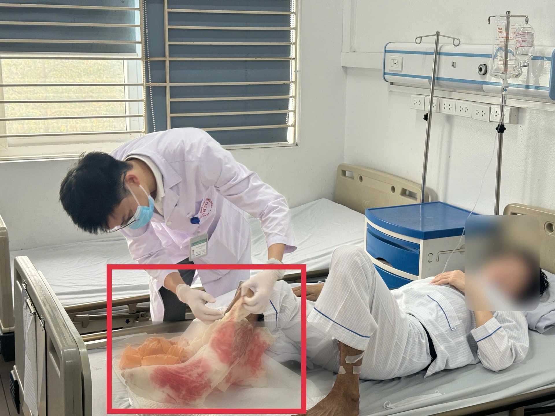 Suýt mất chân sau 1 tháng tự đắp lá chữa bỏng tại nhà- Ảnh 3.