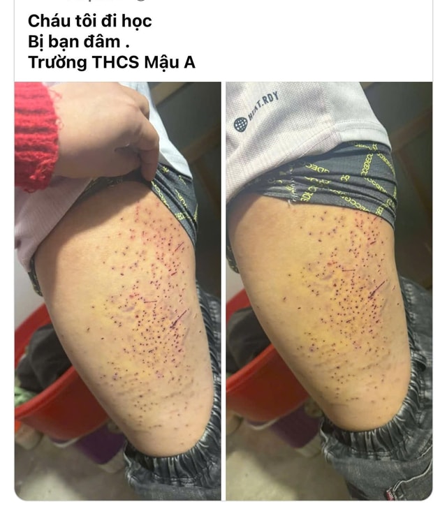 Đã rõ nguyên nhân học sinh lớp 7 ở Lào Cai bị bạn cùng lớp dùng bút đâm vào đùi- Ảnh 2.