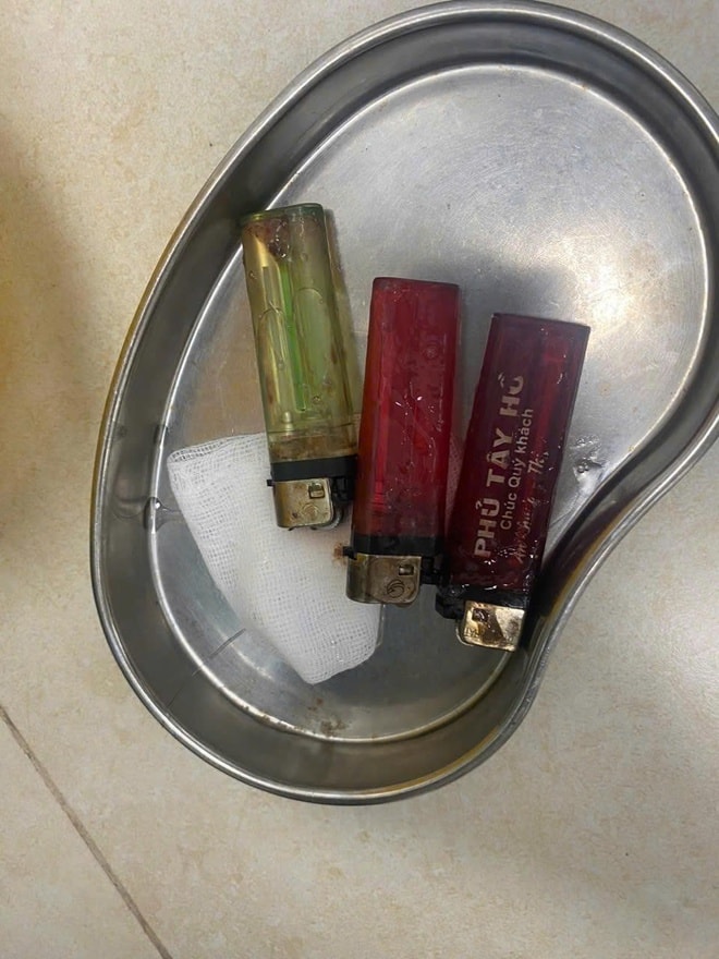 3 chiếc bật lửa trong dạ dày nam thanh niên- Ảnh 3. 3 chiếc bật lửa trong dạ dày nam thanh niên- Ảnh 3.