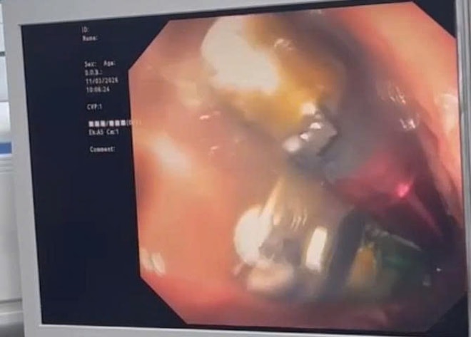 3 chiếc bật lửa trong dạ dày nam thanh niên- Ảnh 2. 3 chiếc bật lửa trong dạ dày nam thanh niên- Ảnh 2.