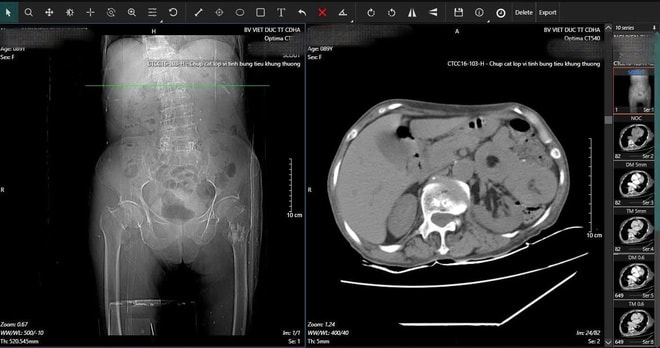 16 ngày, 2 cuộc đại phẫu cứu cụ bà 89 tuổi ở Bệnh viện Việt Đức- Ảnh 1.