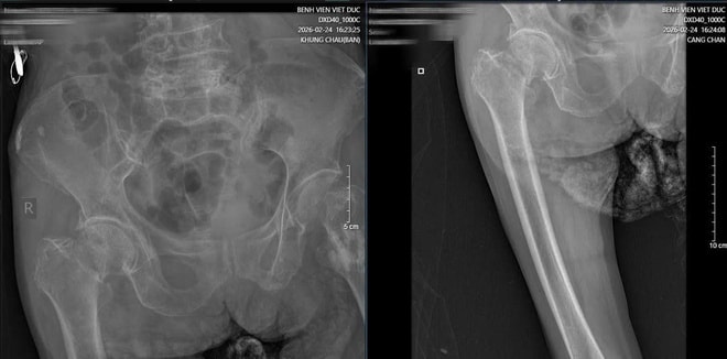 16 ngày, 2 cuộc đại phẫu cứu cụ bà 89 tuổi ở Bệnh viện Việt Đức- Ảnh 2.