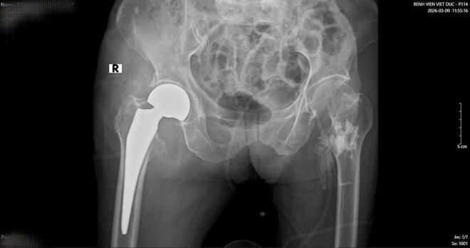 16 ngày, 2 cuộc đại phẫu cứu cụ bà 89 tuổi ở Bệnh viện Việt Đức- Ảnh 3.