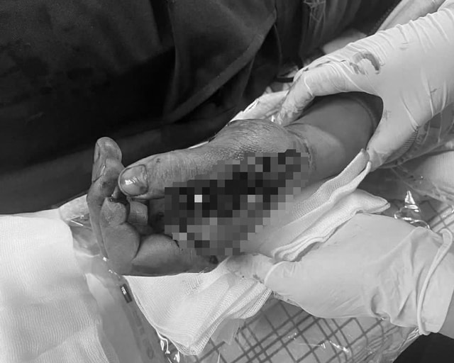 Tai nạn trong tích tắc vì pháo nổ, nam thanh niên suýt mất chức năng bàn tay- Ảnh 3. Tai nạn trong tích tắc vì pháo nổ, nam thanh niên suýt mất chức năng bàn tay- Ảnh 3.