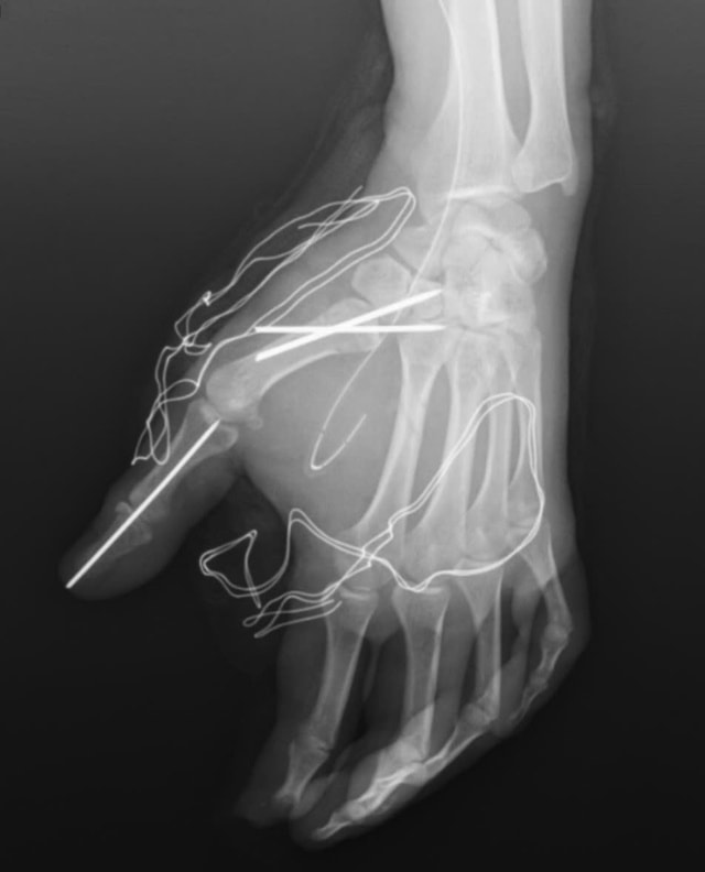 Tai nạn trong tích tắc vì pháo nổ, nam thanh niên suýt mất chức năng bàn tay- Ảnh 1. Tai nạn trong tích tắc vì pháo nổ, nam thanh niên suýt mất chức năng bàn tay- Ảnh 1.