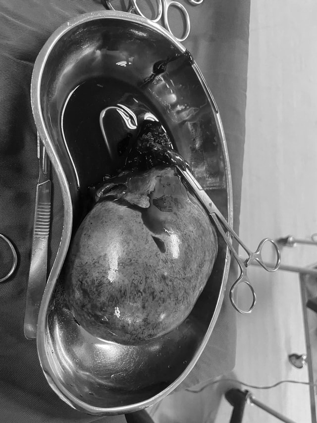 Cứu sống thai phụ có khối u nang biến chứng xoắn, hoại tử- Ảnh 2.