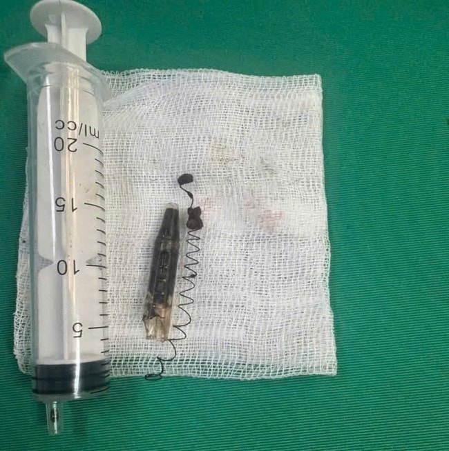 Phẫu thuật lấy dị vật lò xo bút bi 'ngủ quên' 13 năm trong vùng thái dương- Ảnh 2.