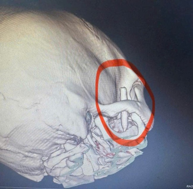 Phẫu thuật lấy dị vật lò xo bút bi 'ngủ quên' 13 năm trong vùng thái dương- Ảnh 1.