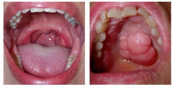 Ngoài thuốc lá, yếu tố nào làm tăng nguy cơ ung thư khoang miệng?- Ảnh 1. Ngoài thuốc lá, yếu tố nào làm tăng nguy cơ ung thư khoang miệng?- Ảnh 1.