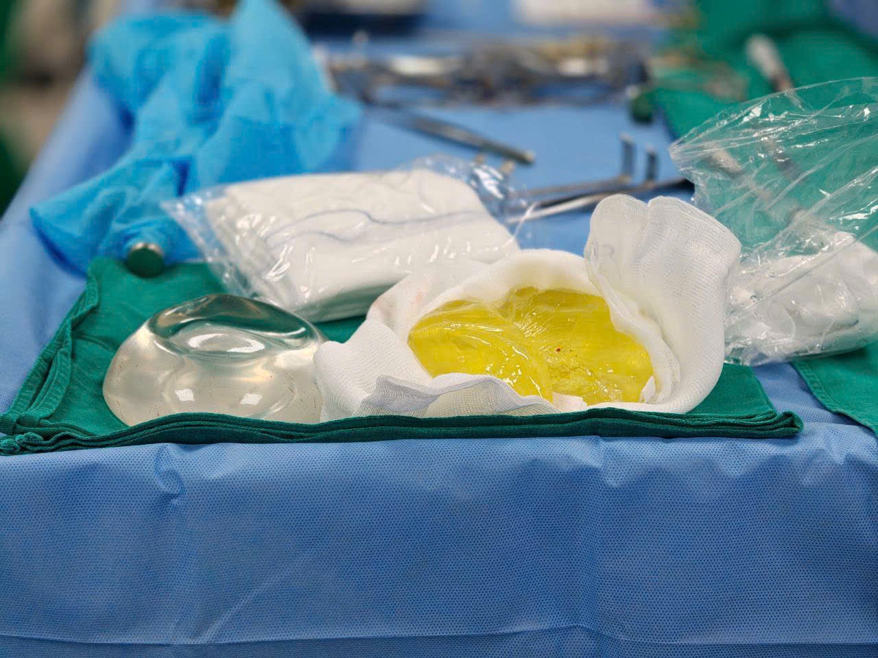 Người phụ nữ tá hoả vì túi ngực vỡ vụn sau 5 năm dù không có cảm giác đau- Ảnh 1.