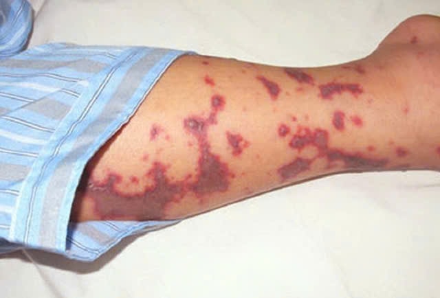 9 bệnh truyền nhiễm nào Bộ Y tế đề xuất phải cách ly y tế chỉ sau vài giờ phát hiện?- Ảnh 1. 9 bệnh truyền nhiễm nào Bộ Y tế đề xuất phải cách ly y tế chỉ sau vài giờ phát hiện?- Ảnh 1.