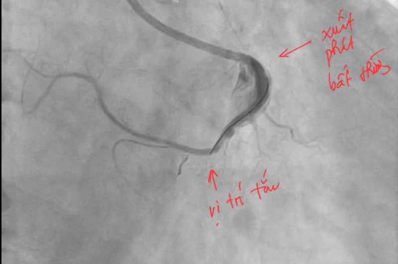 Cứu sống người đàn ông nhồi máu cơ tim cấp dị dạng động mạch vành hiếm gặp- Ảnh 1.