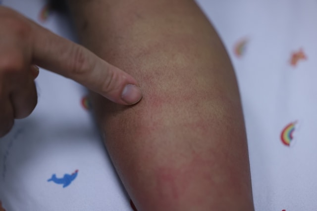 Sốt xuất huyết Dengue và những dự định dở dang bên giường bệnh- Ảnh 2.