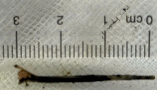 Đau bụng nhiều ngày nhưng chủ quan, người đàn ông phải trả giá vì thói quen phổ biến- Ảnh 1.