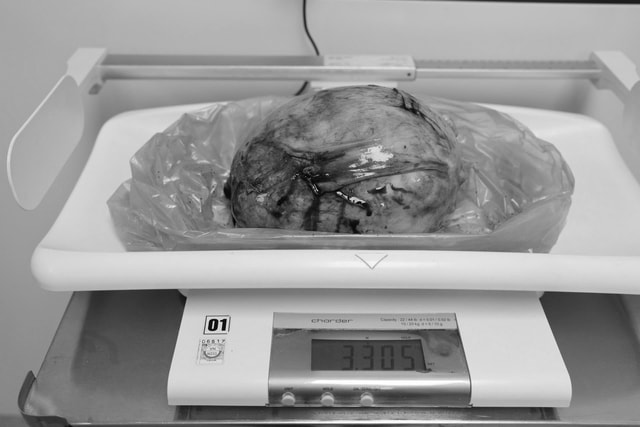 Người phụ nữ có khối u to như thai 7 tháng, nhiều bệnh nguy hiểm- Ảnh 3. Người phụ nữ có khối u to như thai 7 tháng, nhiều bệnh nguy hiểm- Ảnh 3.