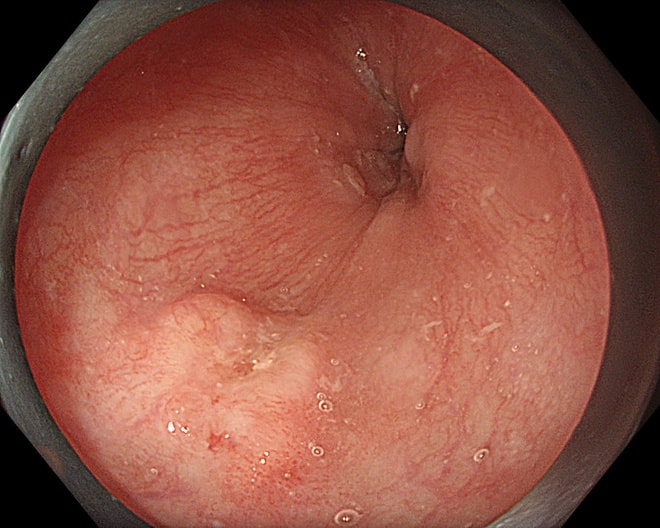 Bệnh viện K ứng dụng hệ thống siêu âm nội soi phóng đại x150 lần, tạo đột phá về tầm soát, điều trị ung thư- Ảnh 4. Bệnh viện K ứng dụng hệ thống siêu âm nội soi phóng đại x150 lần, tạo đột phá về tầm soát, điều trị ung thư- Ảnh 4.