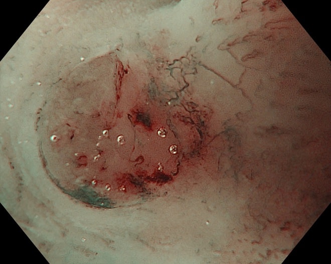 Bệnh viện K ứng dụng hệ thống siêu âm nội soi phóng đại x150 lần, tạo đột phá về tầm soát, điều trị ung thư- Ảnh 5. Bệnh viện K ứng dụng hệ thống siêu âm nội soi phóng đại x150 lần, tạo đột phá về tầm soát, điều trị ung thư- Ảnh 5.