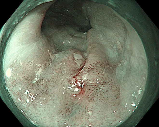 Bệnh viện K ứng dụng hệ thống siêu âm nội soi phóng đại x150 lần, tạo đột phá về tầm soát, điều trị ung thư- Ảnh 3. Bệnh viện K ứng dụng hệ thống siêu âm nội soi phóng đại x150 lần, tạo đột phá về tầm soát, điều trị ung thư- Ảnh 3.