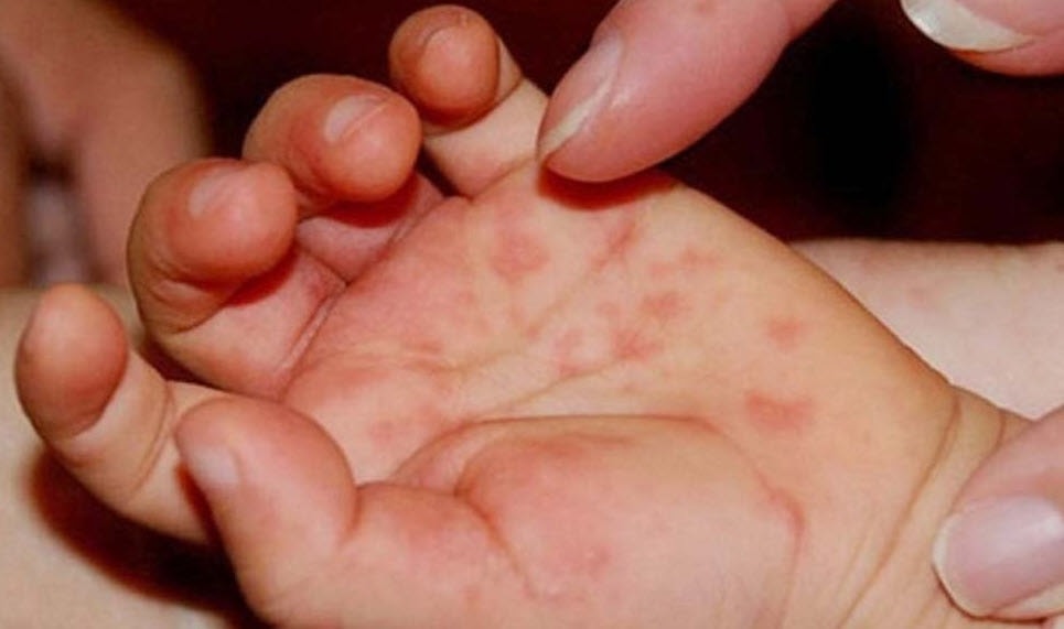 Gần 25.000 ca mắc tay chân miệng, tăng gấp 5 lần: Bộ Y tế chỉ đạo khẩn- Ảnh 1.