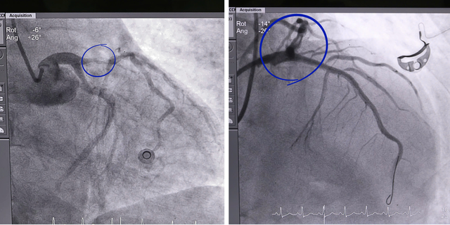 Cứu sống bệnh nhân 65 tuổi sau 3 lần ngưng tim do nhồi máu cơ tim cấp- Ảnh 1. Cứu sống bệnh nhân 65 tuổi sau 3 lần ngưng tim do nhồi máu cơ tim cấp- Ảnh 1.