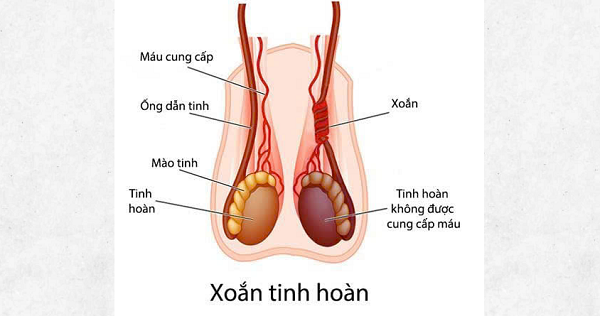 Nam sinh 14 tuổi phải cắt bỏ tinh hoàn do nhập viện muộn- Ảnh 1.