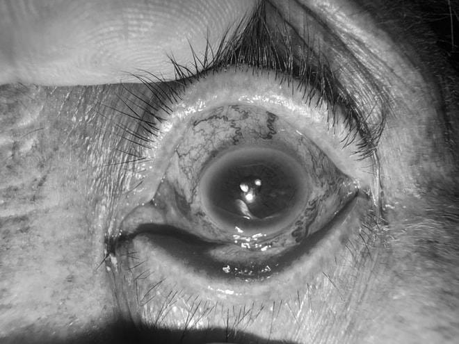 'Giải cứu' mắt lồi do rò động mạch cảnh xoang hang phức tạp bằng can thiệp nội mạch- Ảnh 2.