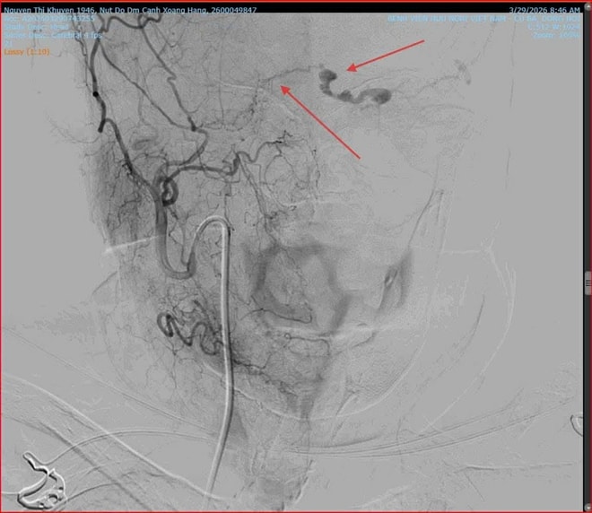 'Giải cứu' mắt lồi do rò động mạch cảnh xoang hang phức tạp bằng can thiệp nội mạch- Ảnh 6.