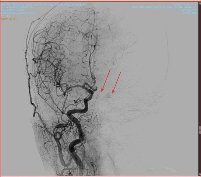 'Giải cứu' mắt lồi do rò động mạch cảnh xoang hang phức tạp bằng can thiệp nội mạch- Ảnh 7.