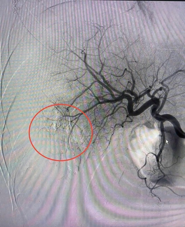 Cứu sống bệnh nhân vỡ gan độ IV bằng kỹ thuật can thiệp nội mạch- Ảnh 3.
