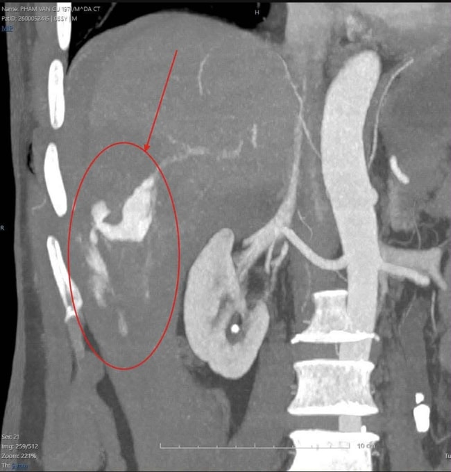 Cứu sống bệnh nhân vỡ gan độ IV bằng kỹ thuật can thiệp nội mạch- Ảnh 2.