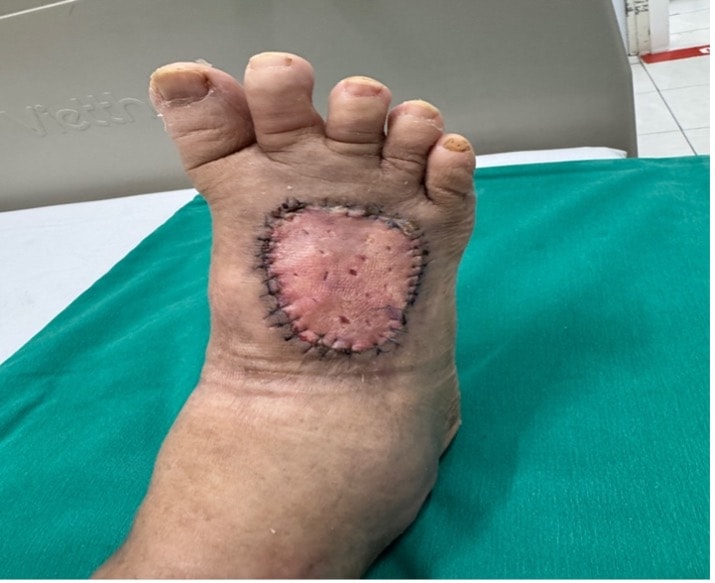 Cứu bàn chân bên bờ cắt cụt cho bệnh nhân đái tháo đường 20 năm- Ảnh 3.