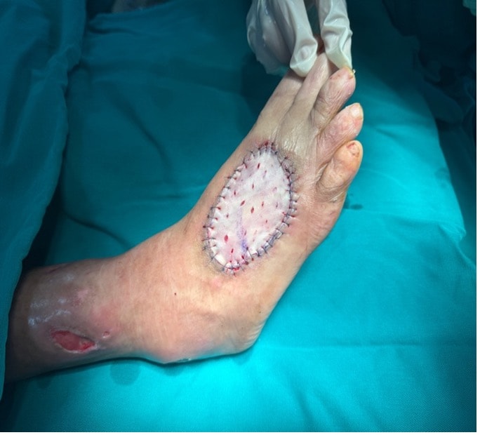 Cứu bàn chân bên bờ cắt cụt cho bệnh nhân đái tháo đường 20 năm- Ảnh 2.