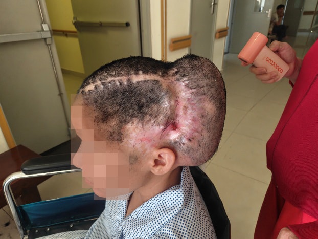 Đột quỵ sau cấy mỡ tự thân, nữ bệnh nhân phải tái tạo hộp sọ- Ảnh 1.