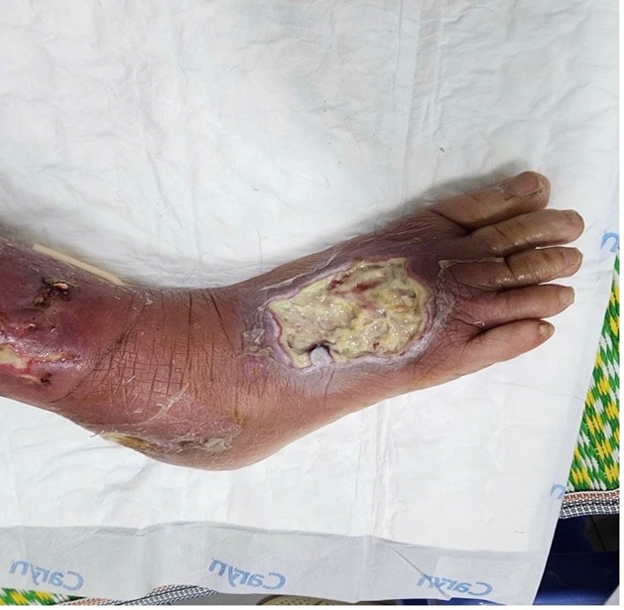 Cứu bàn chân bên bờ cắt cụt cho bệnh nhân đái tháo đường 20 năm- Ảnh 1.