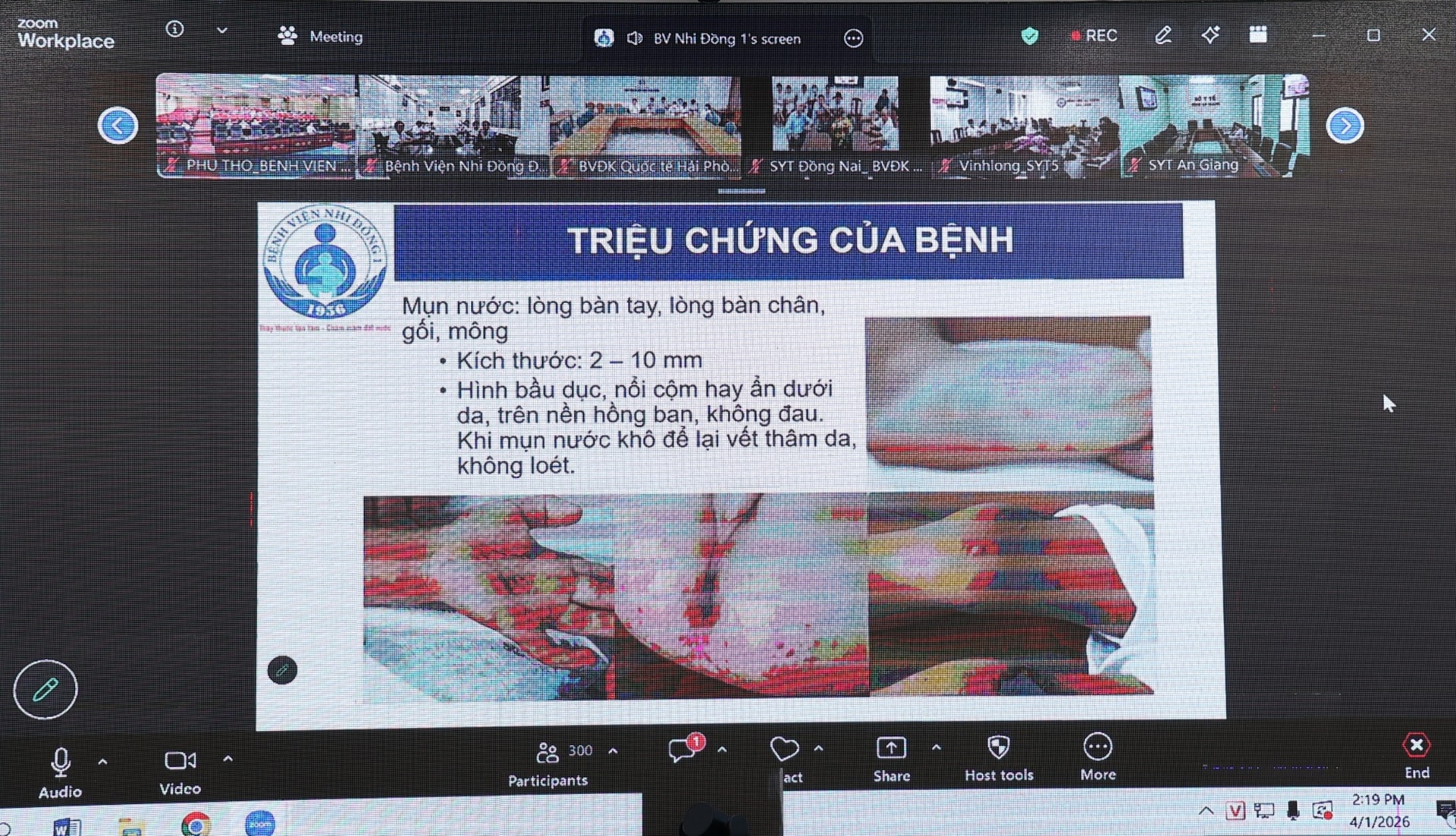 Siết chặt điều trị tay chân miệng: Nâng năng lực hồi sức, đảm bảo cách ly, chuyển tuyến an toàn- Ảnh 4.