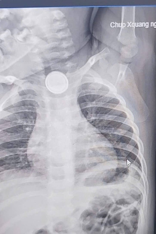 Nuốt pin cúc áo, bé 2 tuổi bỏng nặng thực quản- Ảnh 1.