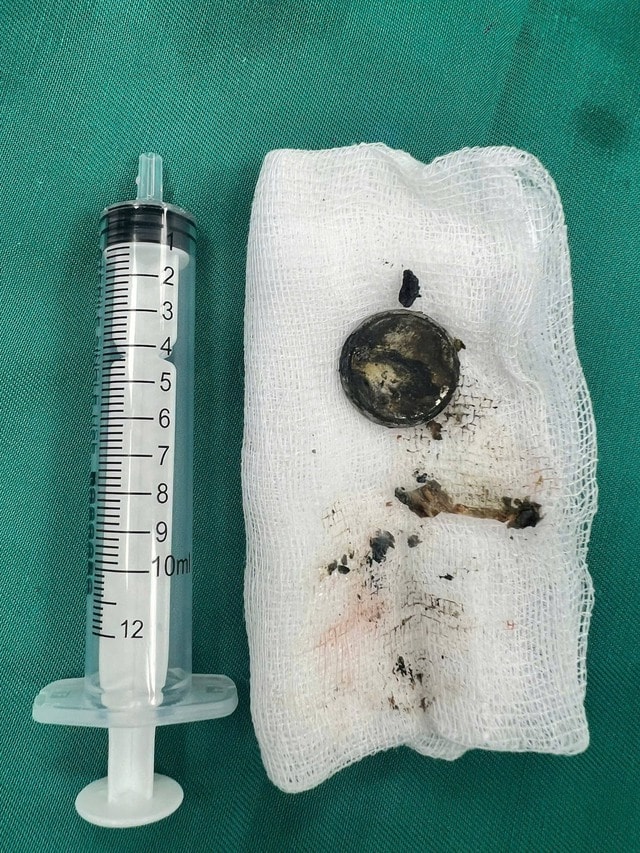 Nuốt pin cúc áo, bé 2 tuổi bỏng nặng thực quản- Ảnh 2.