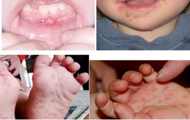 Số ca mắc tay chân miệng tăng cao, Lâm Đồng siết chặt phòng chống dịch- Ảnh 1.