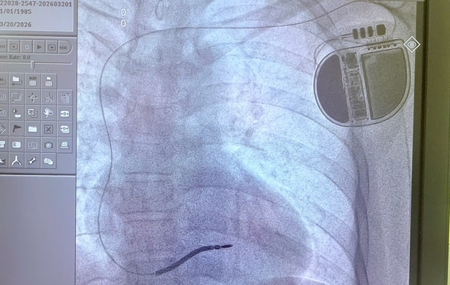 Người đàn ông 3 lần ngất, 1 lần ngưng tim, nguy cơ đột tử cao được cứu nhờ kỹ thuật lần đầu triển khai- Ảnh 1.