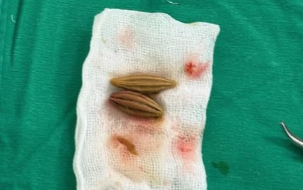 Cụ bà cao tuổi thủng trực tràng vì nuốt hạt nhót- Ảnh 2.