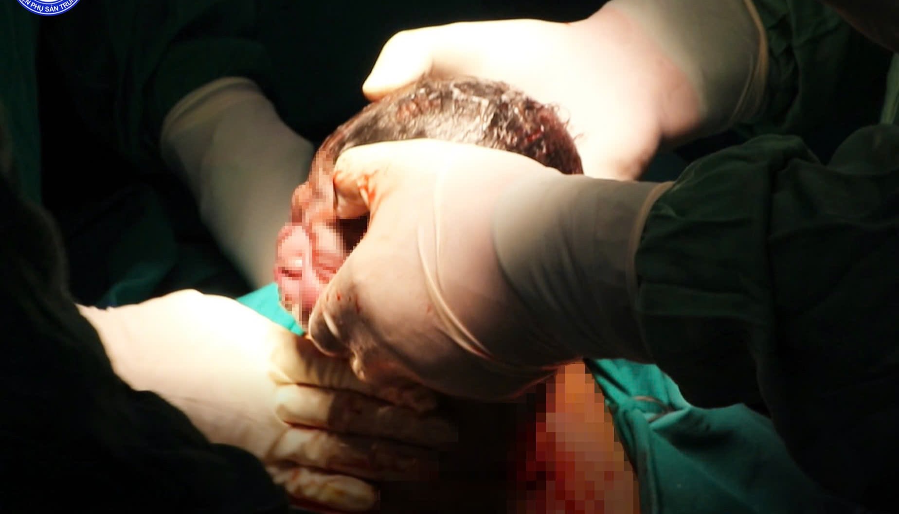 Báo động đỏ trong đêm: 10 phút cứu sống cả mẹ và con từ lằn ranh sinh tử- Ảnh 2.