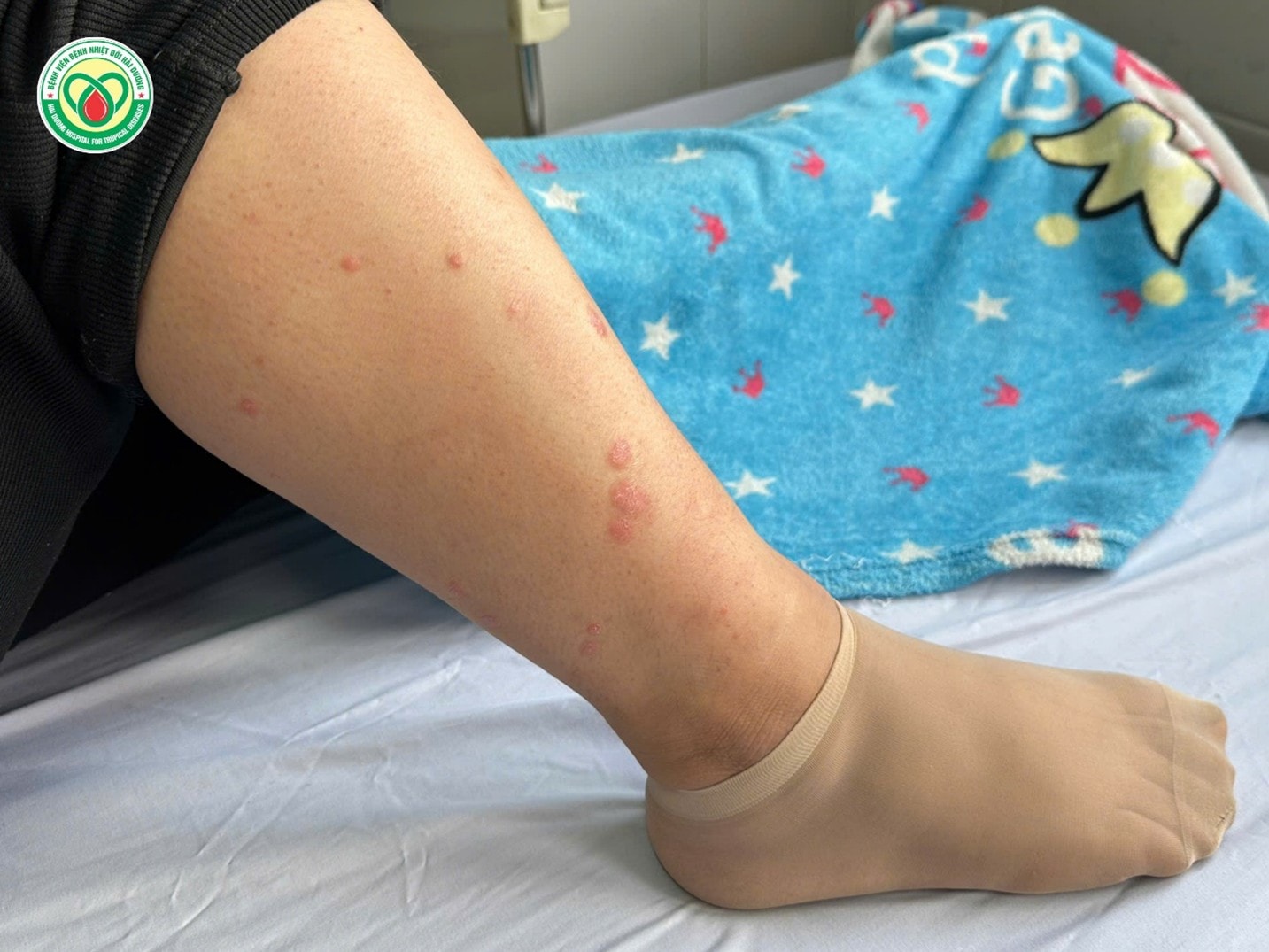 Người phụ nữ 31 tuổi ở Hải Phòng nhiễm cùng lúc 5 loại ký sinh trùng- Ảnh 2.